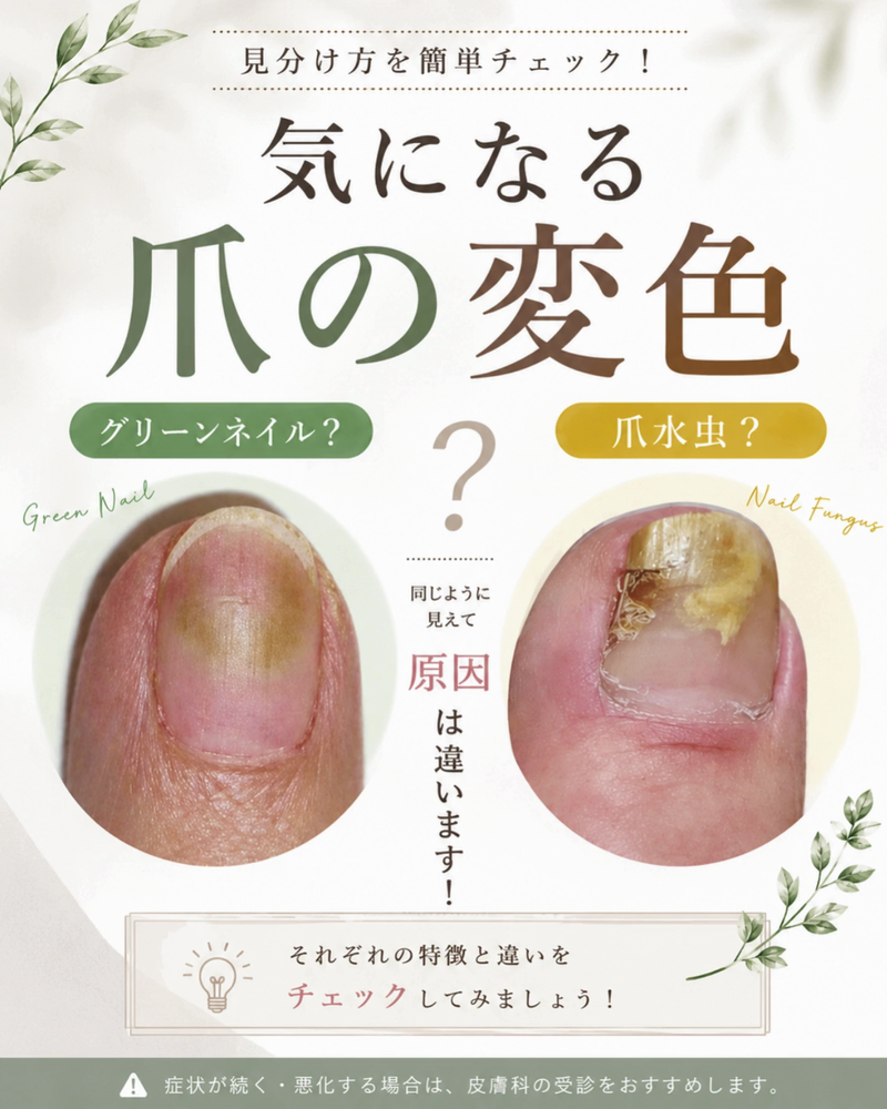 グリーンネイルと爪水虫の違いとは？爪の緑・黄色い変色で知っておきたいこと